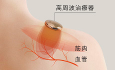 写真:高周波治療器、筋肉、血管