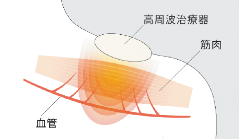 血管、筋肉、高周波治療器