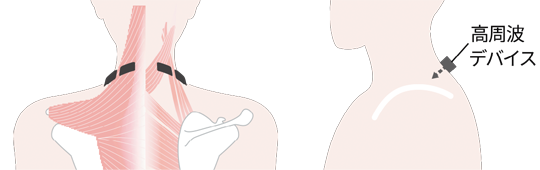 図:EW-RA520 治療イメージ