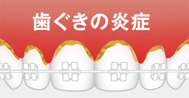 図:口内トラブル 歯ぐきの炎症
