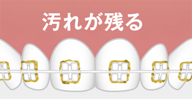 図:口内トラブル 汚れが残る