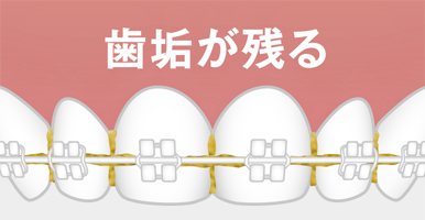 図:口内トラブル 歯垢が残る
