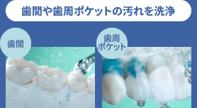 歯間や歯周ポケットの汚れを洗浄。歯間、歯周ポケット。