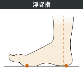 浮き指